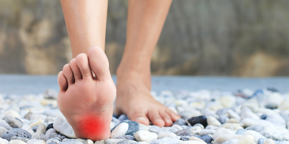 plantar fasciitis